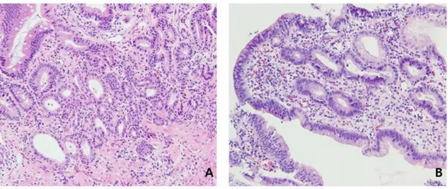 Figure  2.  Typical  pathologic  findings  of  atypical  gland  and  regenerative  atypia  in  cases  indefinite  for  neoplasia/dysplasia