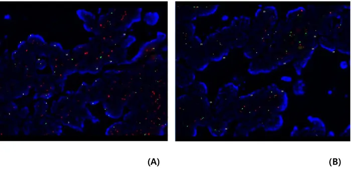 Fig.  2.  Fluorescence  in  situ  hybridization  for  Aurora  kinase  A  (AURKA)  in  colorectal carcinomas showing significant amplification in the 20q13.2–13.33  gain-positive case (A) and no amplification in the case with no copy number gain on  20q13.2