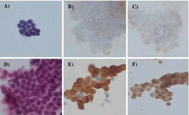 Figure 2. Immunocytochemical findings in fine needle aspiration of benign thyroid disease and  papillary  thyroid  cancer