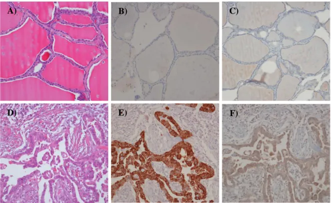 Figure  3.  Immunohistochemical  findings  in  tissue  microarray  of  benign  tumor  and  papillary  thyroid  cancer