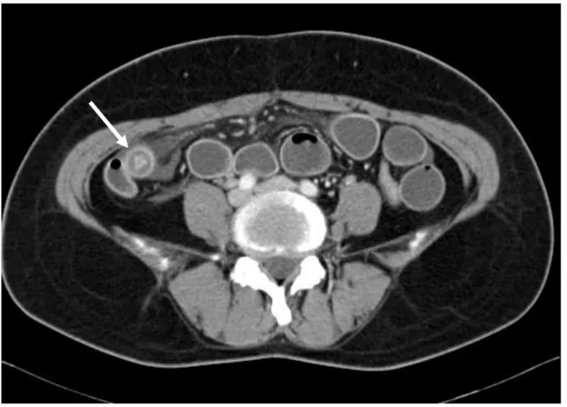 Fig. 3 A 45-year-old woman with serologically diagnosed small bowel anisakiasis.     