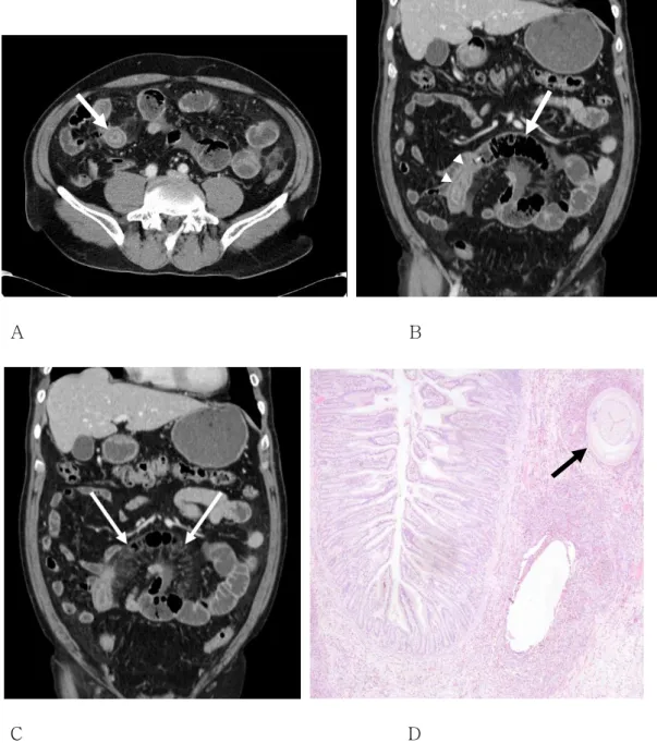 Fig. 4 A-60-year-old man with pathologically confirmed small bowel anisakiasis. 