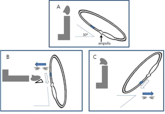 Figure 3. The apogeotropic canaloithiasis in anterior arm of right  horizontal semicircular canal can cause ampullopetal endolymphatic  migration, which induce ipsilesional LDN (A,B)