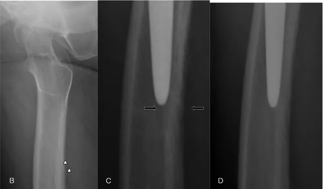 Figure 10. 89 years old male patient with bipolar hemiarthroplasty. (A) Abnormal radiolucent line  (arrow)  by  post-operative  radiograph