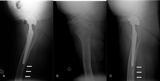 Figure 11. 61 years old female with total hip arthroplasty. (A) Abnormal radiolucent line (arrow)  by operative radiograph