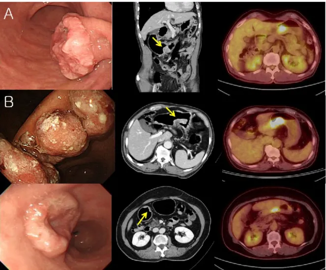 Fig.  1.  EGC  elevated  type.  (A)  EGC  type  I,  adenocarcinoma,  well  differentiated