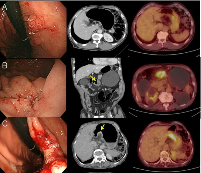 Fig. 2. EGC flat or depressed types (A) EGC type IIb, adenocarcinoma, well differentiated