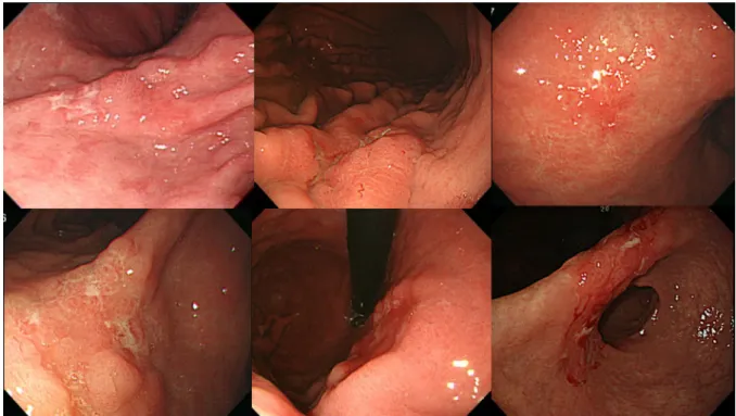 Fig. 3. EGC flat or depressed lesions with negative CT findings and  18 F-FDG uptake 