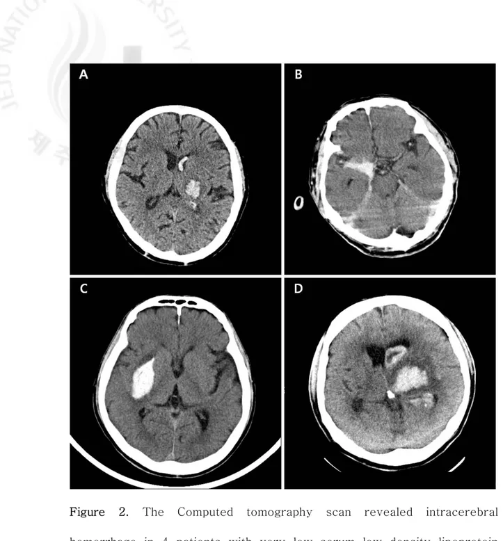 Figure  2.  The  Computed  tomography  scan  revealed  intracerebral  hemorrhage  in  4  patients  with  very  low  serum  low  density  lipoprotein  cholesterol (LDL-C  ≤  40 mg/dL)