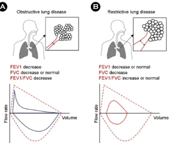 Fig. 3. Characteristics of  obstructive lung disease (A) and restrictive lung disease (B) measured by spirometry