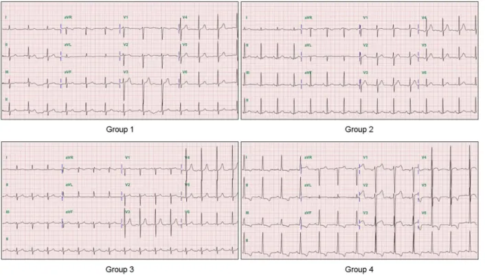 Fig. 3. The electrocardiography findings in four left ventricular remodeling patterns