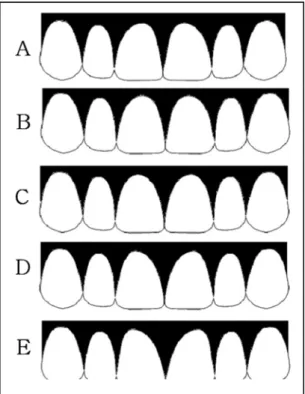 Fig. 4. Gingival margin shape of the central incisor - 2/9 horizontal component of the crown width F : from 4.3 to 6.3, G : from 4.8 to 6.8, H : from 5.3 to 7.3