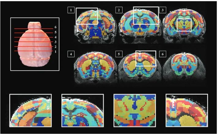 Fig.  3.  3D  rendered  brain  shows  the  slice  number  to  verify  the  location  of  the  segmentations  (Top  left),  segmentations  overlaid  on  3D  T2  image  data  (Top  right  1-6),  Detailed  views
