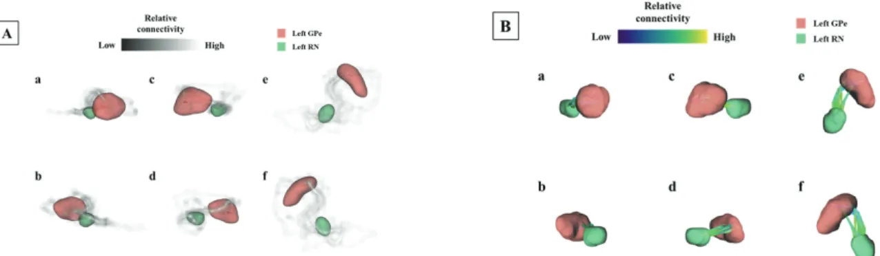 Fig.  5.  Visualization  of  neuronal  pathways  in  GPe-RN  areas  in  Probabilistic  tractography(A)  and  Deterministic  tractography(B)