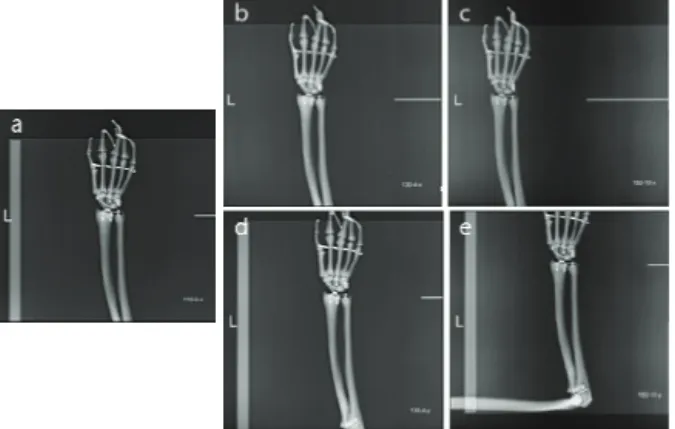 Fig.  2.  (a)  the  reference  image  of  the  wrist  phantom  at  SID  110  cm,  (b)  the  image  of  the  wrist  phantom  moved  4  cm  to  the  X-axis  at  SID  130  cm,  (c)  10  cm  to  the  X-axis  at  SID  150  cm,  and  (e)  moved  4  cm  at  Y-axi