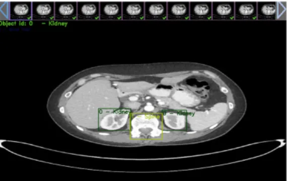 Fig.  1.  Kidney  and  vertebrae  labeling  using  YOLO_mark.