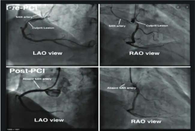 Fig. 1. Percutaneous coronary intervention (PCI).