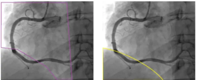 Fig.  11.  Overlapping  section  on  right  heart  shadow  of  lung  and  moving  liver.