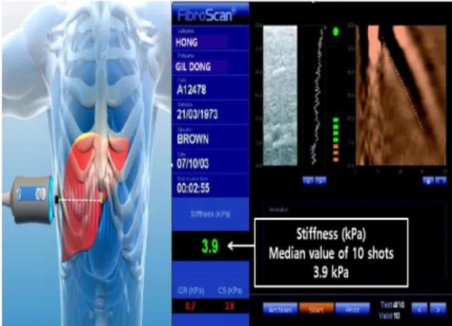 Fig.  1.  Liver  stiffness  measurement  of  transient  elastography  by  fibroscan.