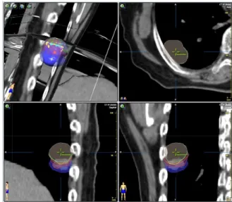 Fig.  1.  Transverse,  sagittal  and  coronal  view  of  all  phase  planning  target  volumes