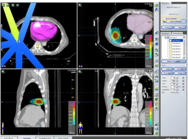 Fig.  2.  3D  radiation  therapy  planning  for  patient  using  4DCT  with  I-plan  system.