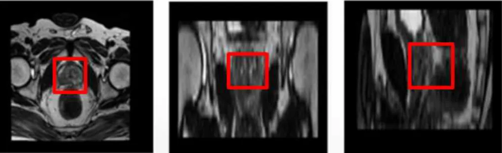 Fig.  4.  Draw  prostate  ROI  on  MPR  view.  Axial  (left),  coronal  (mid),  sagittal  (right).