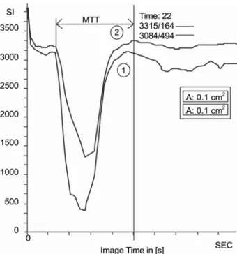 Fig. 2. Time-to-signal intensity curves of perfusion weighted MR images obtained 30minutes after oleic acid embolization in  Fig