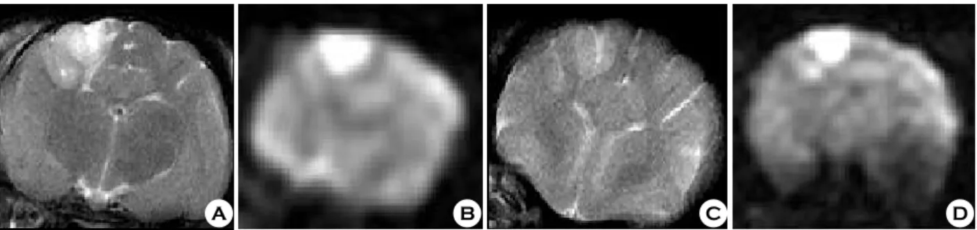 Fig. 4. MR images of T2-weighted (A) and diffusion-weighted (B) images obtained 30 minutes and T2-weighted (C), diffusion-weighted  (D) images cat obtained 2 hours after fat embolization