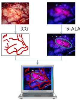 Fig. 2. Image process, image registration method overview  using the ICG and 5-ALA. 