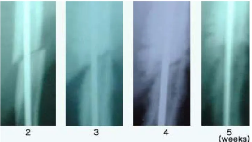 Figure  1.  Radiograms  of  treatment  group.  The  callus  was  formed  at  2∼3  weeks(average  2.5  weeks).