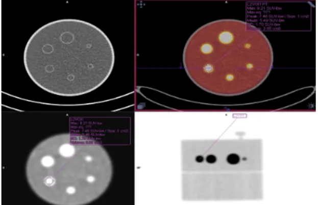 Fig.  3.  By  setting  the  interesting  areas  with  automatic  mode  on  6  globes,  SUVmax  of  PET-CT  screen  image  (transverse  plane)  was  measured