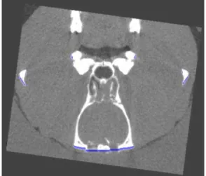 Fig. 15. Upper boundary detection of cranial bone. 