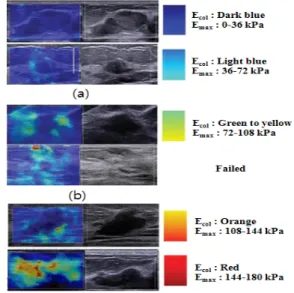 Fig.  1.  Shear  wave  elastography  and  B  mode  images    in  showing  stiffness. 