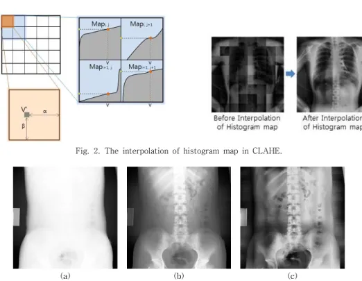 Fig.  3.  Comparison  of  HE  and  CLAHE.  (a)  Original  X-ray  image,  (b)  HE,  (c)  CLAHE(Block  size  8×8,  Threshold  parameter  0.5).