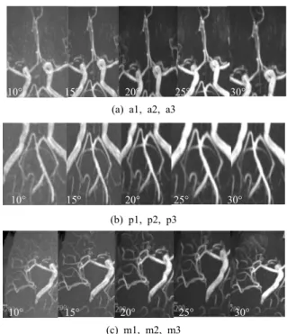 Fig.  4.  The  SNRs  and  CNRs  values  according  to  the  change  of  flip  angle  when  using  TOF  technique  in  9 
