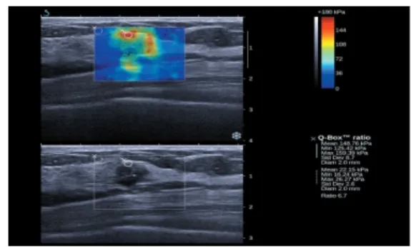 Fig.  1.  Shear  wave  elastography  and  B  mode  images  of  a  benign  fibrocystic  change