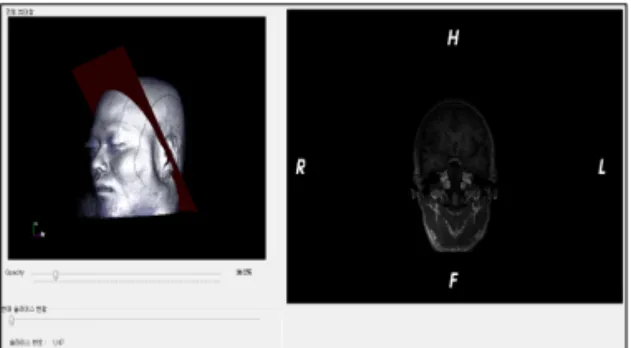 Fig. 5. A perpendicular slice of brain image to  oblique  axis of hippocampus.