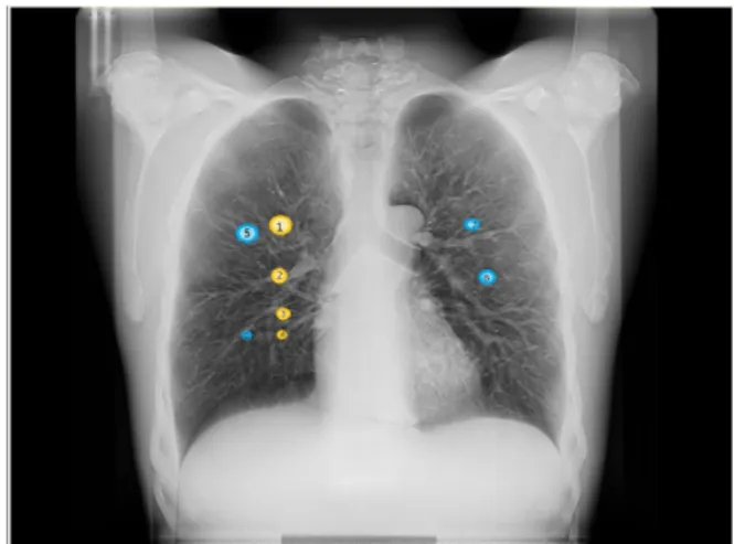 Fig.  1.  Eight  artificial  nodules  placed  in  the  lung. 