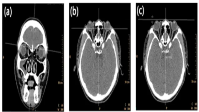 Fig.  1.  The  MSP  was  set  up  the  basis  of  nasal  septum  as  a  standard  at  coronal  plane  of  reconstructed  image(a),  The  slice  is  selected  for  measurement  of  the  angle  at  axial  plane  of  reconstructed  image(b),  The  angle  betw