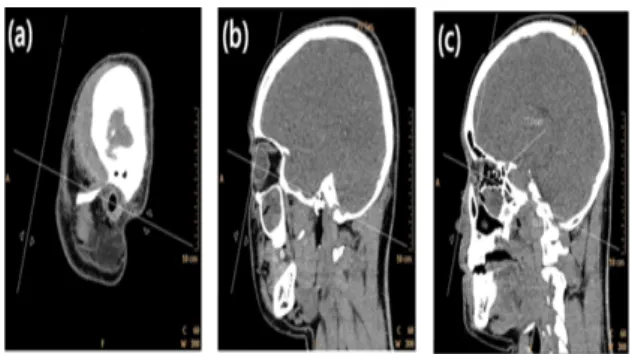 Fig.  3.  The  angle  between  Rt.  optic  foramen  and  MSP  was  measured  at  the  axial  image  of  MPR.