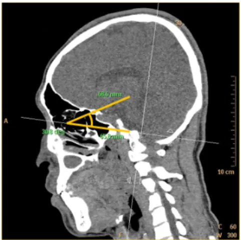 Fig.  5.  The  angle  between  Rt.  optic  foramen  and  OML  was  measured  at  the  sagittal  image  of  MPR.