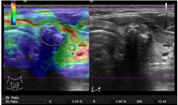 Fig.  1.  Example  of  elastograpy.