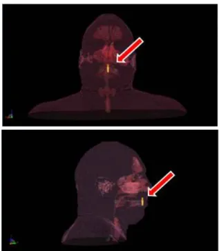 Fig.  5.  Head  temperature  change  of  human  head  phantom  without  using  detal  implant.