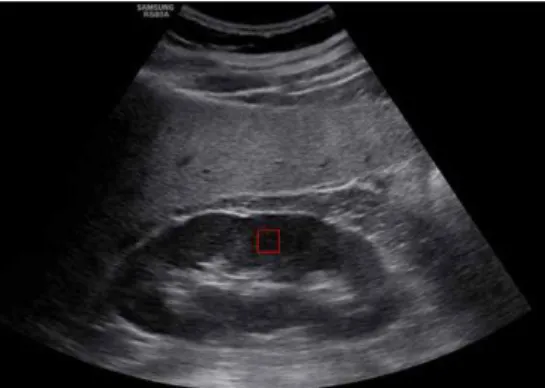 Fig.  1.  Brightness  ROI  of  Kidney  sonogram.