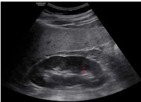 Fig.  3.  Normal  kidney  ultrasound  image.