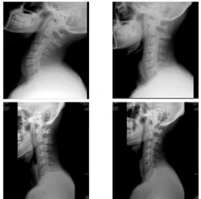Fig.  1.  Measuring  the  cervical  vertebra  (before  /after)  by  using  diagnostic  radiation  equipment.