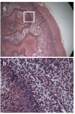 Fig.  6.  (a)  Tumor  characterized  by  hyper-cellurality  and  multinucleate  gigantic  cells