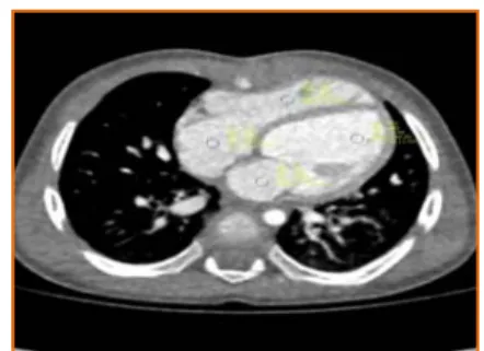 Fig.  1.  Quantitative  evaluation  method  for  the  cardiac  enhancement  image  were  used  Hounsfield  unit  (HU) 