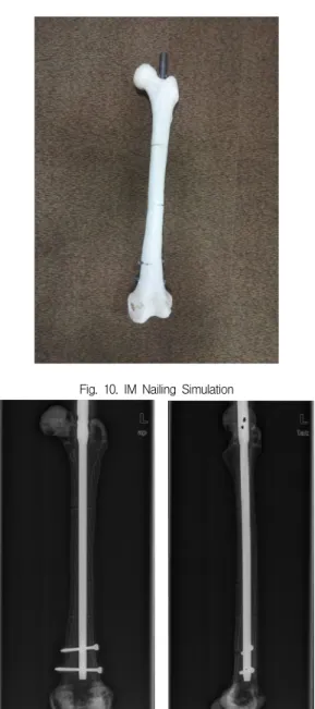 Fig.  11.  IM  Nailing  Simulation  X-ray  Image