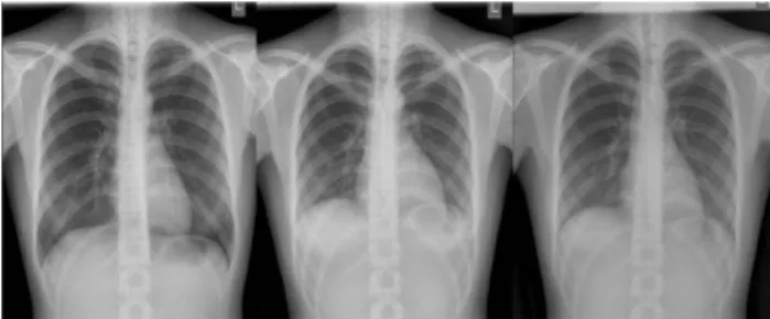 Fig. 3. Radiographic image for the Chest PA X-ray (Lt.;